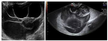 The majority of cysts are harmless. The Characteristic Ultrasound Features Of Specific Types Of Ovarian Pathology Review
