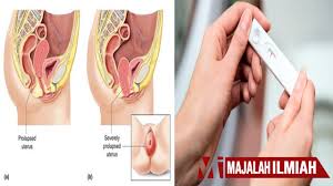 Tahukah anda peranakan jatuh adalah antara punca utama sukar untuk hamil, peranakan jatuh yang lebih di kenali sebagai prolapse atau rahim turun boleh juga berlaku, di sebabkan kelemahan pada otot pelvik yang menampung kedudukan rahim atau jika ada tekanan tinggi dalam abdomen yang boleh. Susah Hamil Ini Tanda Tanda Punca Serta Kesan Buruk Rahim Jatuh Majalah Ilmiah