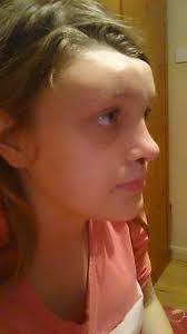 Student who lost half her skull after tumour was misdiagnosed as an allergy  to her pet rabbit now has a 3D-Printed replacement