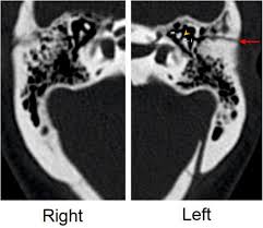 Image result for Ossicular Chain Disruption