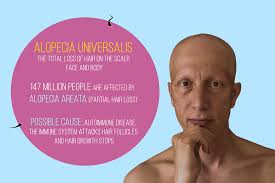 Alopecia universalis has not been proven to be related to stress. My 23 Pics Show The Advantages And Disadvantages Of Having Alopecia Universalis Success Life Lounge