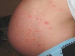 Ibc does not usually cause lumps to form in breast tissue. Rash Between Breasts Causes Treatment And Prevention