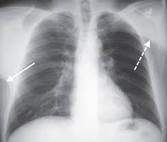 Unilateral Hyperlucent Hemithorax Radiology Key