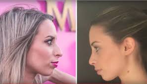 Quisemos saber mais sobre a it girl, que já tanto conquistou no mundo do digital. Clinica Fmr Clinica Fmr Helena Coelho Rinolastia