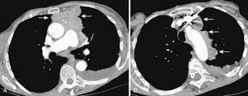 Learn about pleural effusion including causes of pleural effusion. The Pleura Radiology Key