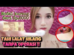 Banyak cara yang dapat digunakan untuk menghilangkan tahi lalat dengan alami tanpa melakukan operasi. Menghilangkan Tahi Lalat Tanpa Operasi Marisha Chacha Youtube