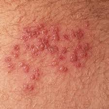 Ist es bei einem 4 monate altem baby wirklich nicht mehr so gefährlich wenn es herpes. Herpes Genitalis Herpesinfektion Med Kom