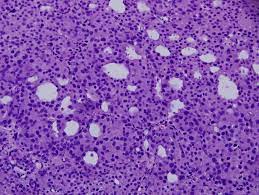 The pathologist checks the samples to see how similar the tumor tissue looks to normal prostate tissue. Pathology Outlines Adenocarcinoma
