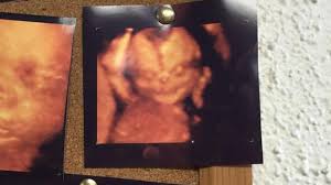 Pasalnya setelah melakukan usg, hasil foto dan video janin perempuan kembar yang dikandungnya nampak tak akur dan terekam sedang saling adu jotos satu sama lain ketika masih ada dalam perut. Hasil Usg 4 Dimensi Ini Menyeramkan Health Liputan6 Com