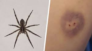 Image result for spinne biss haut reaktion