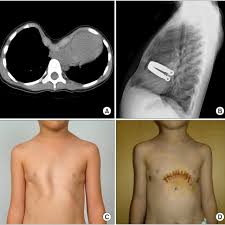 In severe cases, pectus excavatum can look as if the center of the chest has been scooped out, leaving a deep dent. A A 3 Year Old Boy Had Severe Pectus Excavatum With A Pectus Index Of Download Scientific Diagram
