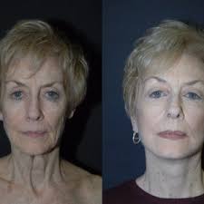 Beck treats every patient like . Bay Area Aesthetic Surgery 150 Photos 109 Reviews Cosmetic Surgeons 66 Bovet Rd San Mateo Ca United States Phone Number Yelp