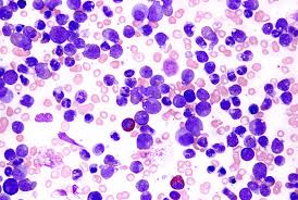 Es posible que la leucemia afecte los glóbulos rojos, los glóbulos blancos y las plaquetas. Leucemia Mieloide Cronica Sintomas Causas Y Tratamiento