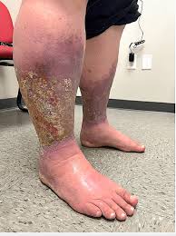 Image result for Stasis Dermatitis