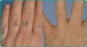 Before (left) after (right) tattoo removal. Indian Ink Tattoo Removal North Bristol Nhs Trust