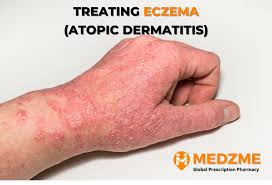 Eczema (Atopic Dermatitis) Global Treatment Guide | Medzme