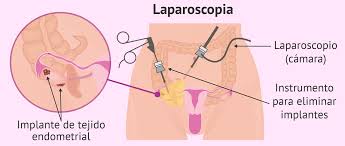Diagnóstico de la endometriosis: analíticas y pruebas de imagen