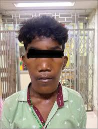 Van Buchem disease: A rare sclerosing dysplasia