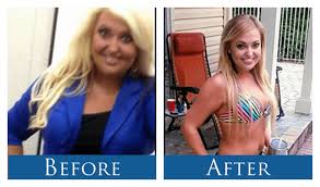 Pin On Weight Loss Surgery