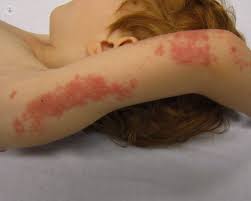Herpes Zoster Que Es Sintomas Y Tratamiento Top Doctors