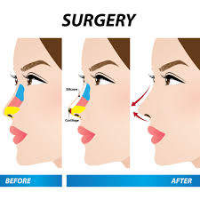 At your free nose job consultation, your rhinoplasty surgeon will ask you about the results you want to achieve from the surgery. The Rhinoplasty Clinic Philadelphia Pa Glen Mills Rhinoplasty Clinic