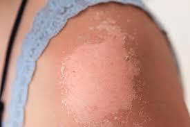 Skin that's hot or warm to the touch Why Your Skin Peels After A Sunburn According To Dermatologists Allure