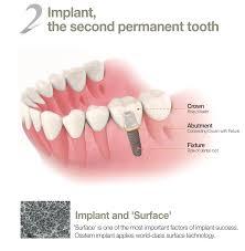 Harga scaling di klinik gigi kerajaan, penskaleran, scaling, cuci gigi di klinik kerajaan, karang gigi, plak. ç§ç‰™ Dental Tooth Implants Malaysia Tanam Gigi Malaysia Dentist Malaysia