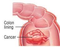 The portion of an animal body that consists of ectoderm and mesoderm, forms the external body surface, and encloses the body cavity. Bowel Obstruction Guide Causes Symptoms And Treatment Options