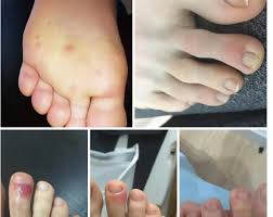 Elak samping, yaitu mengelak dengan cara memindahkan kaki ke samping dan posisi badan dimiringkan. Spanyol Curigai Lesi Di Kaki Sebagai Gejala Awal Covid 19 Republika Online