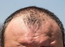 Get in the habit of being kind to your hair. Top 5 Treatments For Male Pattern Baldness In 2021