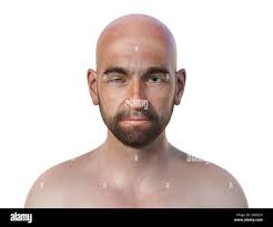 Image result for Anhidrosis