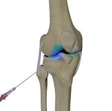 Image result for Knee Injection