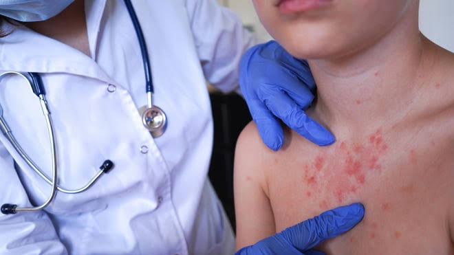 Why Two Measles Deaths in Pennsylvania Sparked a Federal-State War Over Vaccines