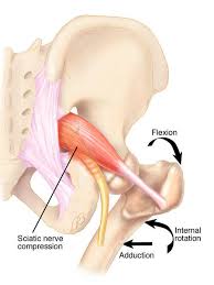 Check spelling or type a new query. The Ultimate Guide To Piriformis Syndrome Treatment