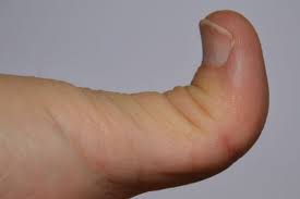 Joint Hypermobility Mepedia