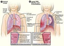 Pleurisy Wikipedia