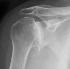 Image result for Shoulder XRay