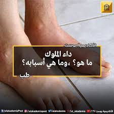 داء الملوك ماهو وما هي أسبابه داء النقرس Gout هو مرض يتميز بآلام متكررة في المفاصل مع التهاب ناتج من تجمع كريستالات حمض اليوريك في فراغات المفاصل مما يؤدي إل