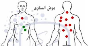 طبق اليوم بالصور مواضع حجامة داء السكري