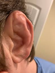 Go to an experienced and qualified piercer instead of doing your own piercings. Cauliflower Ear Wikipedia