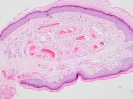 Cherry angiomas, also known as campbell de morgan spots or senile angiomas, are cherry red papules on the skin. Cherry Angioma Cherry Hemangioma Senile Angioma Campbell De Morgan Spot Dermatology Advisor