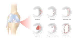 In other animals they may be present in other joints. Verletzung Des Meniskus Bewahrte Behandlungsmethoden Klinik Pyramide