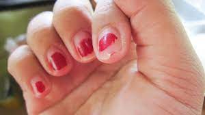 Pourquoi Faut Il Arreter De Se Ronger Les Ongles