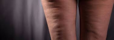 Cellulite is a condition that is characterized by a dimpling, puckering, or orange peel appearance of the skin that is most commonly seen on the thighs and buttocks. 15 Myths And Facts About Cellulite Abc News
