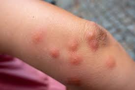 Image result for flea bites