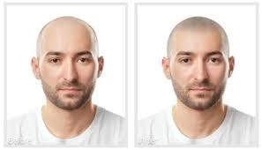 Fondamentalmente la micropigmentazione è definita come un tipo di tatuaggio che include la tecnica del microblading. Tricopigmentazione Un Valida Alternativa Al Trapianto Capelli