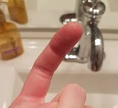 How to fix clogged milk duct. Clogged Duct Relief Long Post October 2017 Babies Forums What To Expect