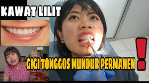 Saya melakukan perawatan behel 6 bulan, gigi tonggos pakai behel jadi mundur dan rapi perawatan gigi behel bukan. Gigi Tonggos Mundur Permanen Pakai Kawat Lilit Pada Behel Youtube