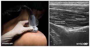 Image result for Axillary Nerve Block