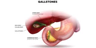 Sakit ulu hati setelah operasi batu empedu. Sakit Maag Tidak Kunjung Sembuh Waspadai Batu Empedu